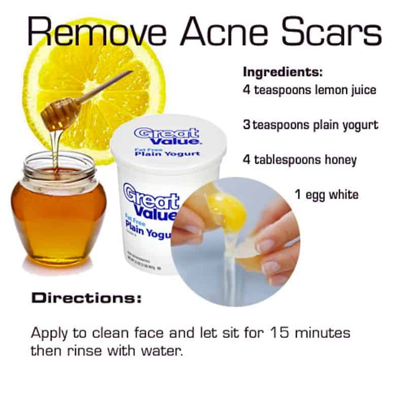 Remove acne scars